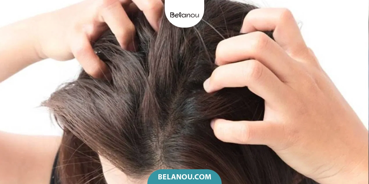 زن در حال خاراندن سر به دلیل شوره و خشکی
