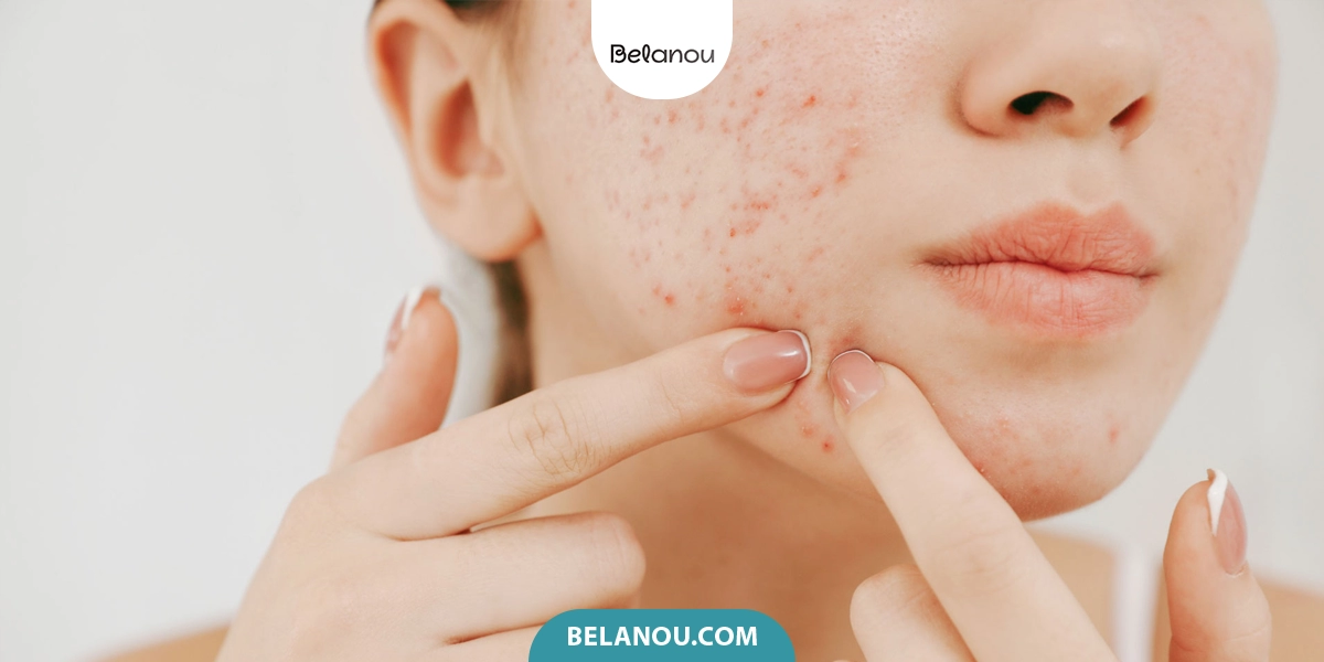از بین بردن جای جوش در یک روز