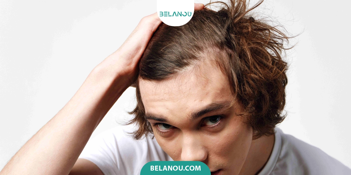 آلوپسی آندروژنیک از شایع‌ترین ریزش مو
