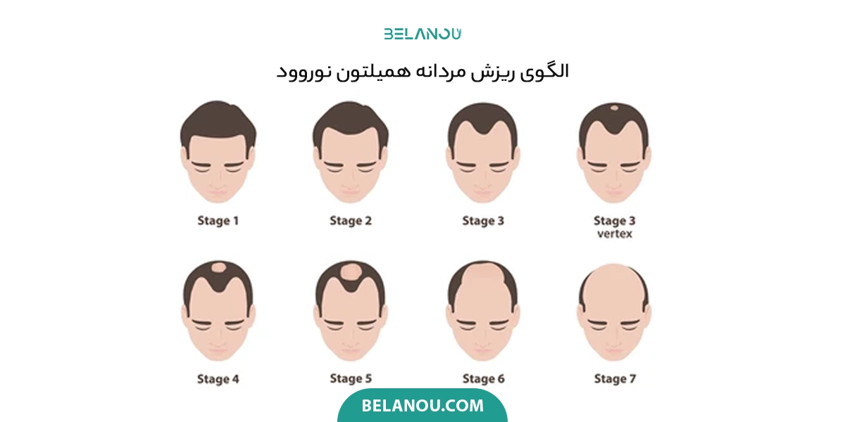 الگوی ریزش موی مردانه