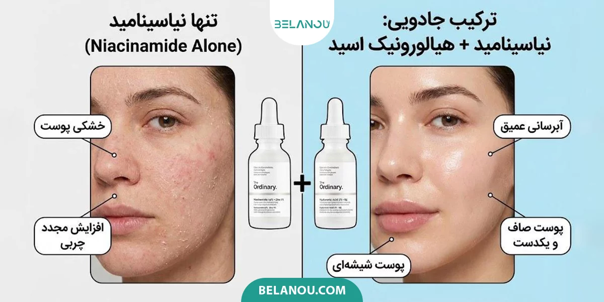 ترکیب نیاسینامید و هیالورونیک اسید برای درمان منافذ باز پوست 