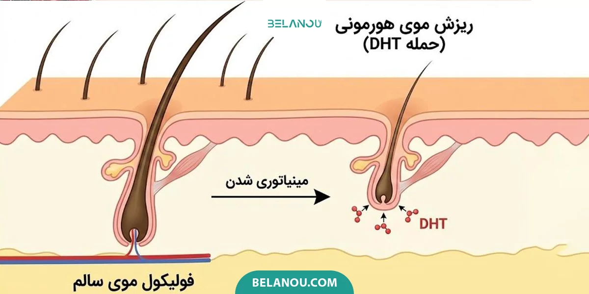 بررسی ریزش مو هورمونی